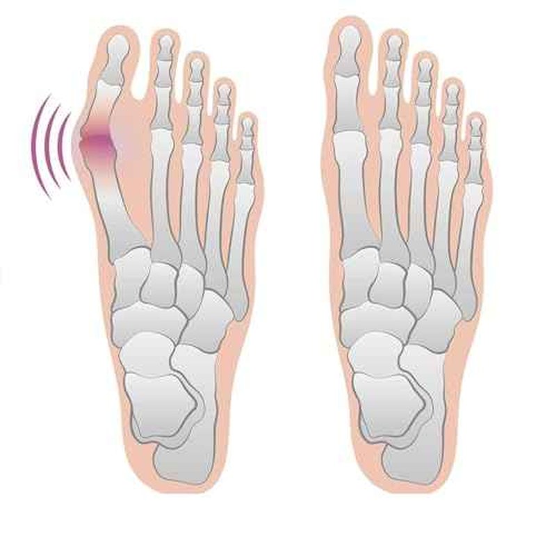 4 Bunion Relief Pads and Sleeves, Orthopedic Bunion Corrector Socks with Gel Pads, 2 Pairs