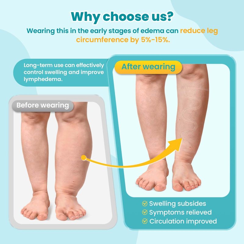 Sylong® Swelling Edema Calf Compression Wrap Adjustable Sleeve For Lower Leg Lymphedema Circulation (XL)