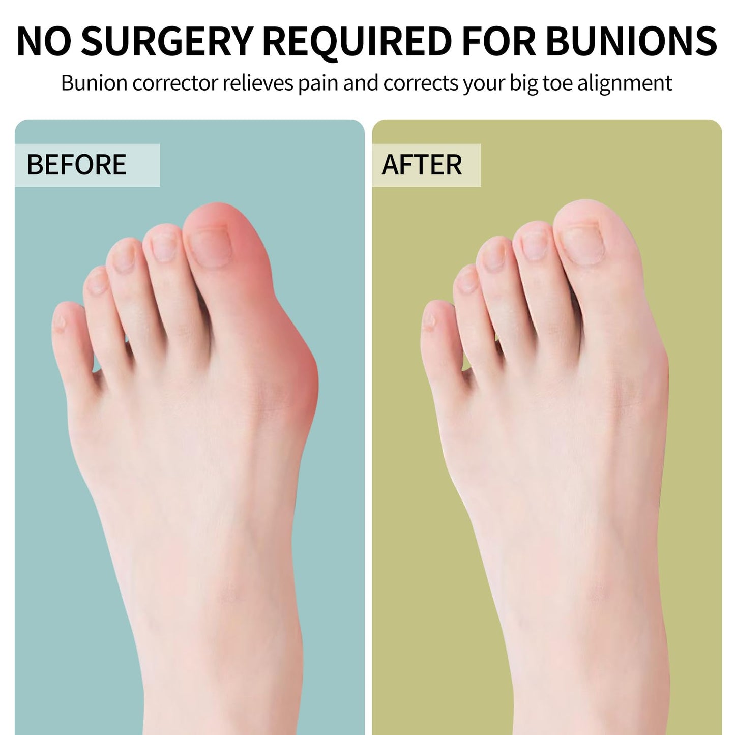 Erouevnket Bunion Corrector for Women & Men ：2-in-1 Adjustable Big Toe Relief Bunion Splints Hammer Toe Straightener，Comfortable, Effective Double Correction，1 set