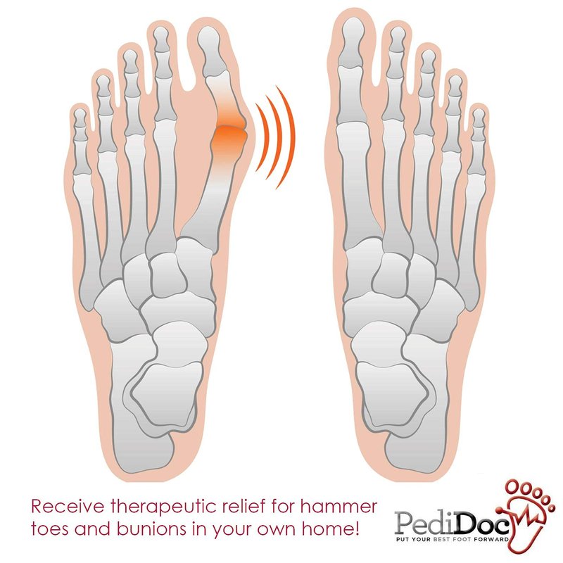 PediDoc Bunion Corrector Bunion Toe Straightener for Big Toe Bunion Relief Strap and Splint Restores Natural Alignment of Overlapping and Crooked Toes Toe Spacer and Stretcher for Hallux Valgus