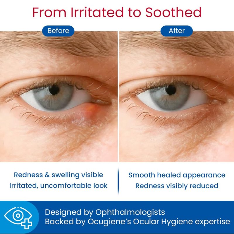 Stye-press: Adhesive Hydrocolloid Patches for Styes & Chalazia: Provide immediate Cosmetic Improvement, Help Absorb Secretions, Reduce Redness, Swelling & Prevent Scarring