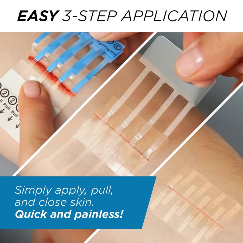 Clozex Emergency Laceration Kit - Repair Wounds Without Stitches, Skin Closure Device for a Wound Up to 1 1/2 Inches Length. Complete Kit to Clean, Close, & Cover Wounds