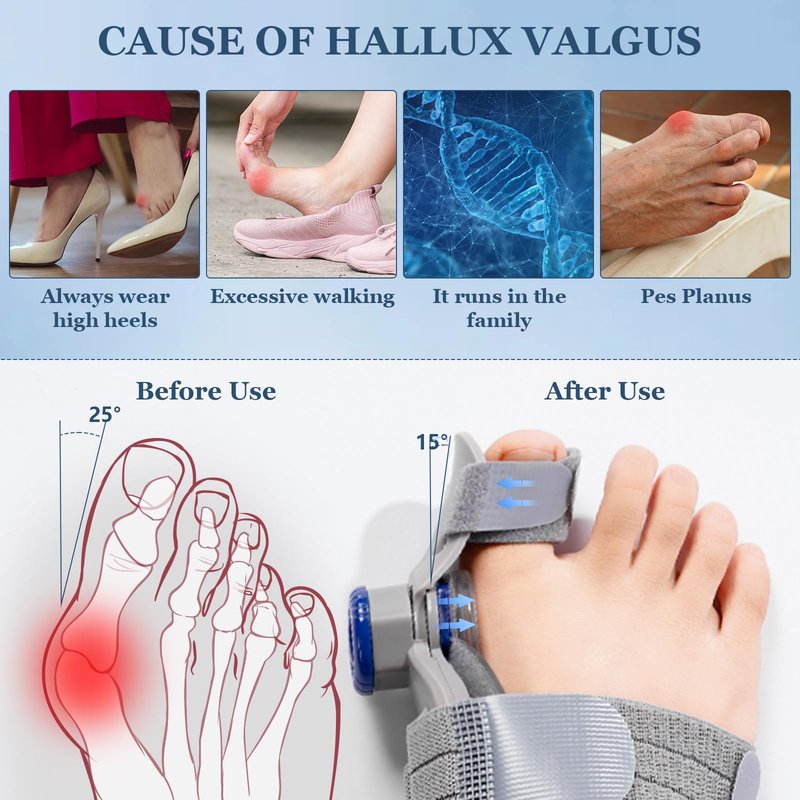 Bunion Corrector for Women Men, Adjustable Big Toe Straightener Bunion Fix, Bunions Splint Brace with Non Slip Separators, Treatremedy Alignment Correction for Hallux Valgus Foot Pain Relief