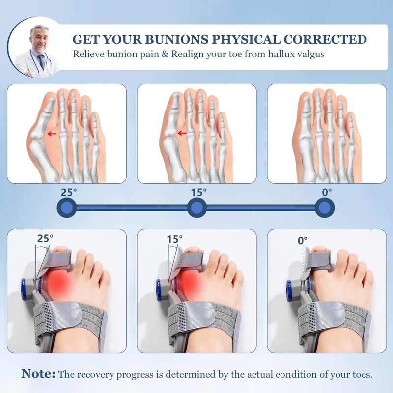 Bunion Corrector for Women Men, Adjustable Big Toe Straightener Bunion Fix, Bunions Splint Brace with Non Slip Separators, Treatremedy Alignment Correction for Hallux Valgus Foot Pain Relief