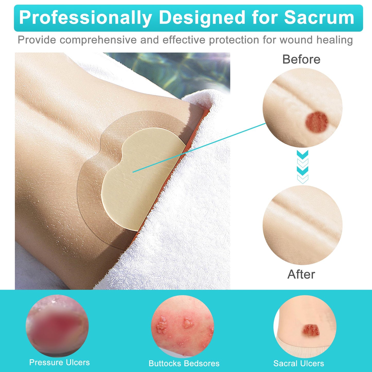 Sacrum Silicone Foam Dressing with Gentle Border, Sacrum Wound Bandages, Breathable Waterproof Sacral Dressing for Pressure Ulcers, Sacral Ulcers and Buttocks Bedsores (7" x 7", Pack of 5)